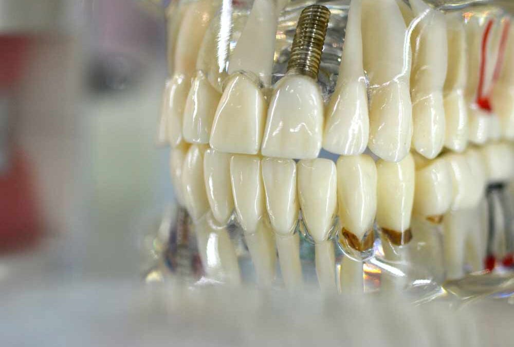 Ventajas de las prótesis dentales: mejora tu sonrisa y salud