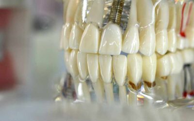 Ventajas de las prótesis dentales: mejora tu sonrisa y salud